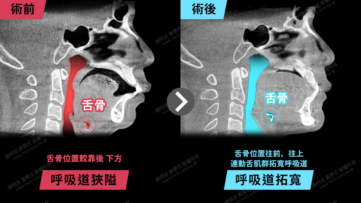 從AHI 64.5到4.3!術後重獲清醒人生 1 正顎手術前後呼吸道斷層對比,術後舌骨往前上移動、呼吸道拓寬