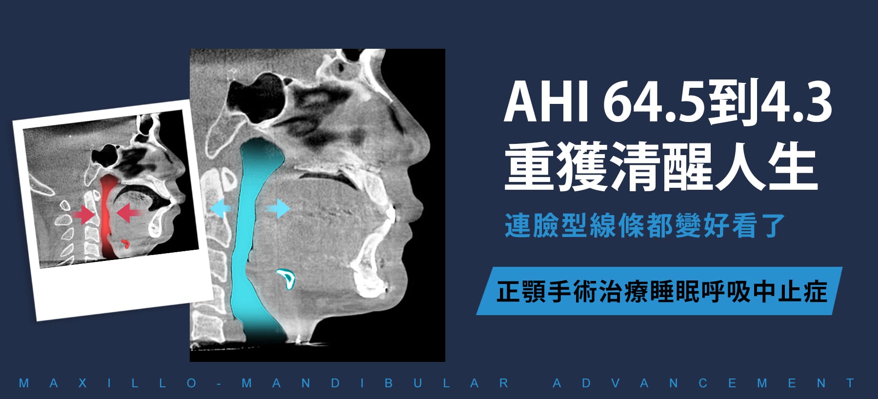 正顎手術治療睡眠呼吸中止症案例主視覺，AHI由64.5降至4.3