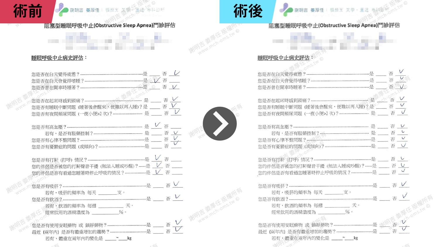 從AHI 64.5到4.3!術後重獲清醒人生 4 阻塞型睡眠呼吸中止門診評估表術前與術後填答對比