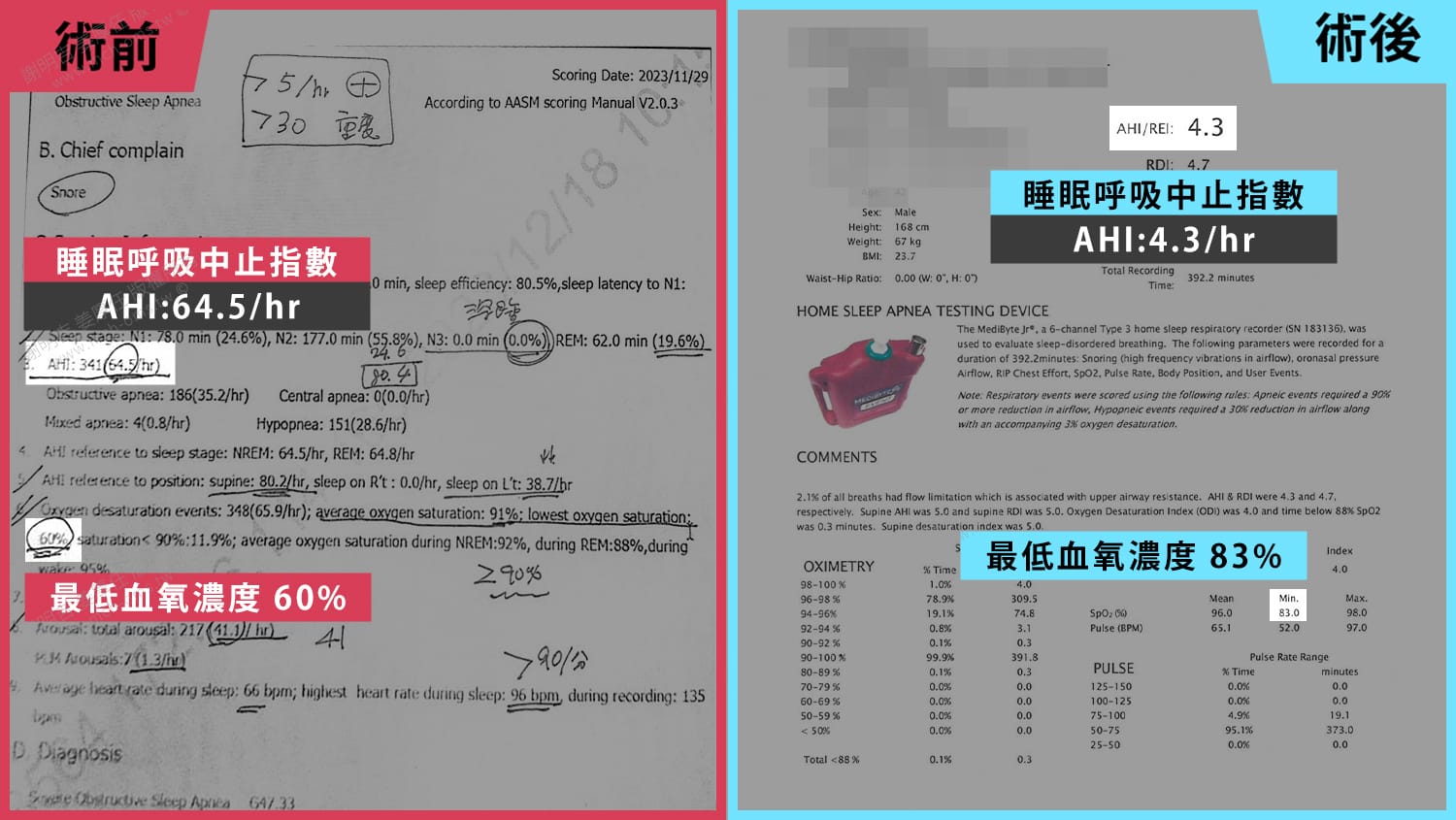 從AHI 64.5到4.3!術後重獲清醒人生 3 術前術後睡眠檢測報告對比,AHI由64.5降至4.3、最低血氧由60%提升至83%