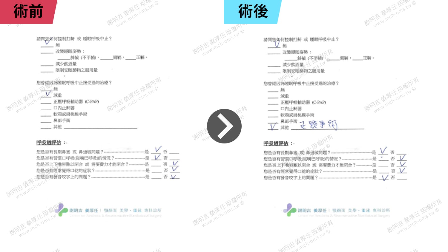 從AHI 64.5到4.3!術後重獲清醒人生 5 門診評估表呼吸道評估欄位術前術後對比,術後治療欄填寫正顎手術