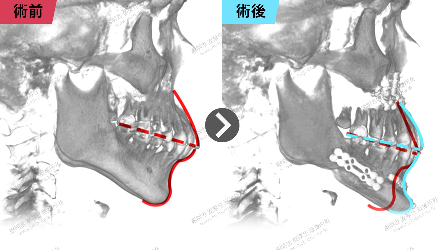 從AHI 64.5到4.3!術後重獲清醒人生 2 正顎手術前後上下顎骨位置與咬合平面變化的3D斷層對比