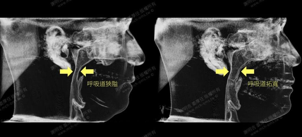 鼾聲如雷竟是呼吸中止症惹的禍 6 正顎手術前後呼吸道電腦斷層對比,由狹隘變為拓寬