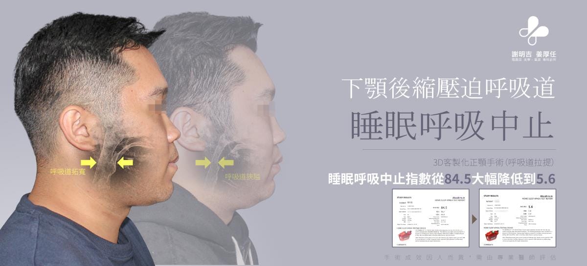 下顎後縮患者3D客製化正顎手術前後側臉與呼吸道對比