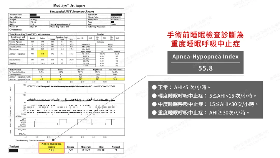 頭痛易怒原來是嚴重阻塞性睡眠呼吸中止惹得禍 1 術前睡眠檢查報告,AHI 55.8判定為重度睡眠呼吸中止症