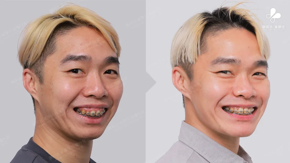 MMA surgery to treat sleep apnea 6 Comparison of 45-degree angled smile appearance before and after orthognathic surgery