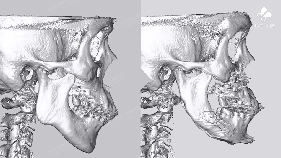 MMA Surgery to Treat Sleep Apnea 9 3D tomographic comparison of craniofacial skeleton before and after counterclockwise rotation and forward mandibular surgery