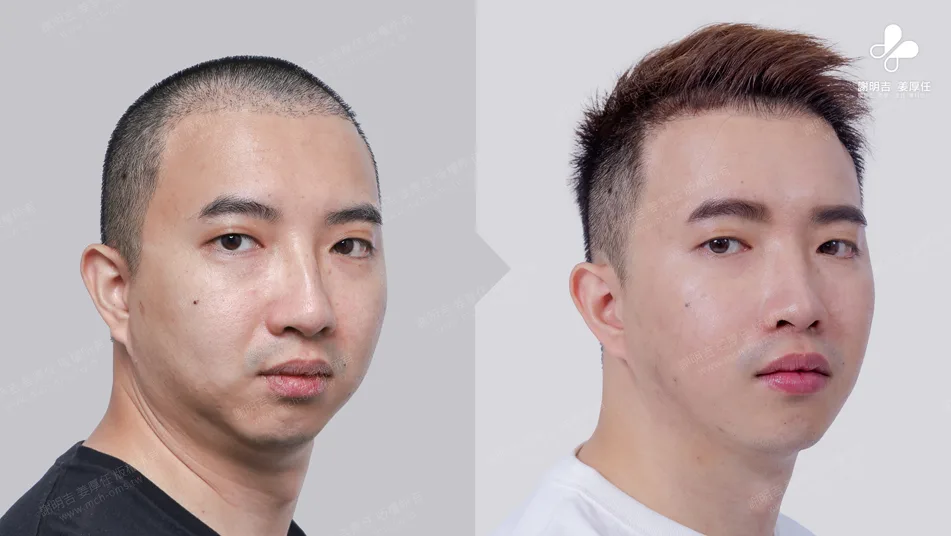 頭痛易怒原來是嚴重阻塞性睡眠呼吸中止惹得禍 5 MMA上下顎前移手術前後45度斜面外觀對比