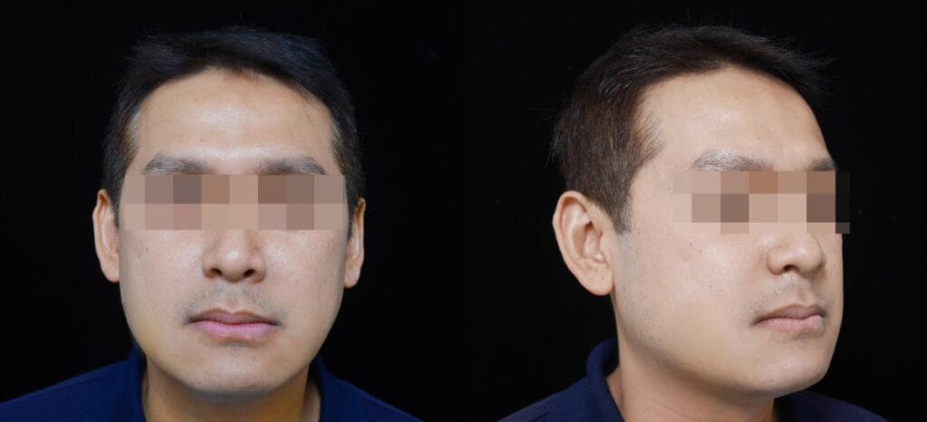 鼾聲如雷竟是呼吸中止症惹的禍 7 正顎手術後一週回診的正面與斜側面外觀