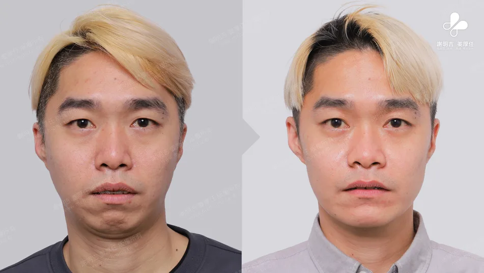 MMA surgery to treat sleep apnea 3 Frontal appearance comparison before and after orthognathic surgery for patients with mandibular retrusion