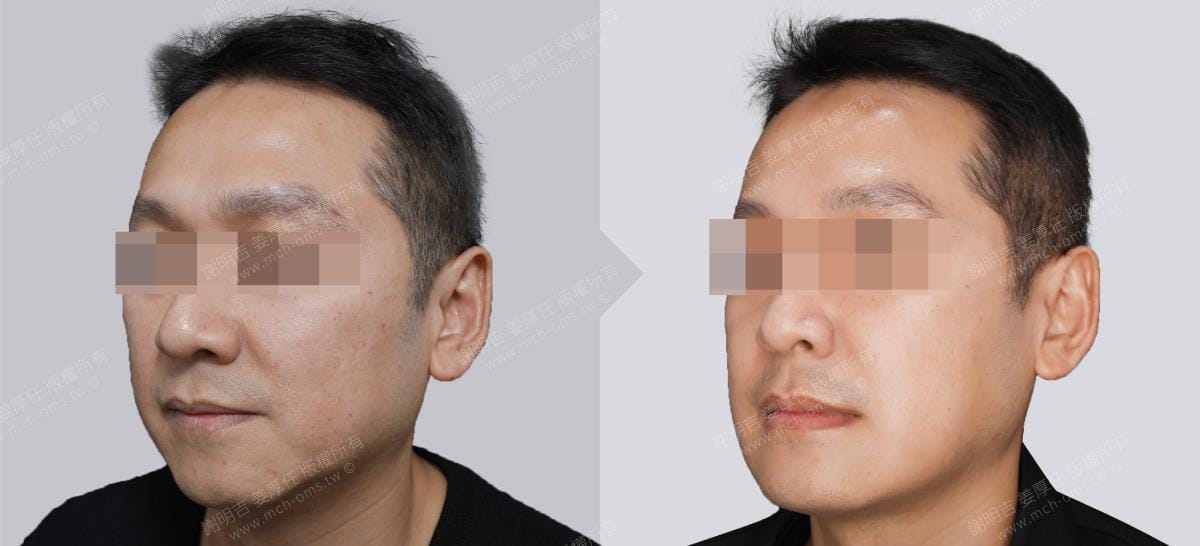 鼾聲如雷竟是呼吸中止症惹的禍 3 正顎手術前後左側45度斜面外觀對比