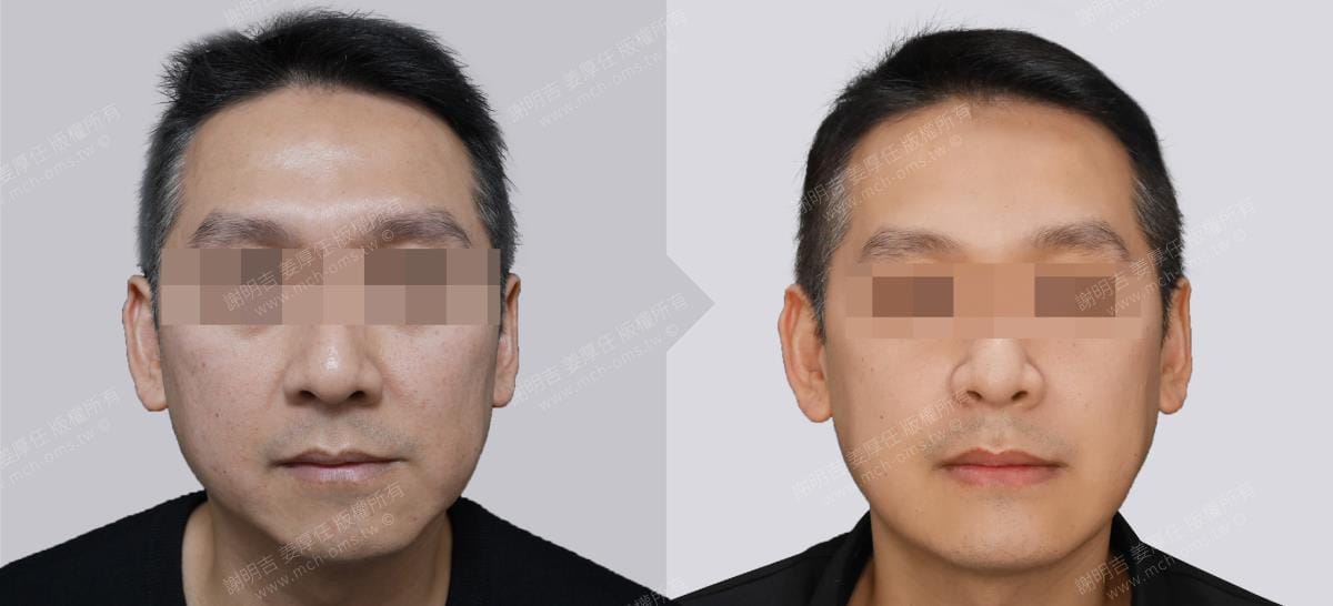 鼾聲如雷竟是呼吸中止症惹的禍 1 MMA正顎手術前後正面外觀與臉型對比