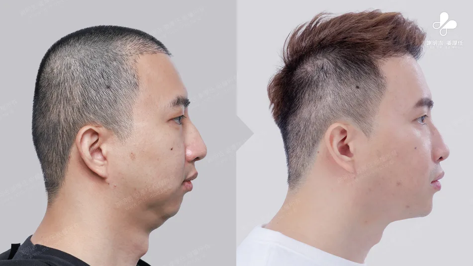 頭痛易怒原來是嚴重阻塞性睡眠呼吸中止惹得禍 7 MMA手術前後側面下顎與下巴輪廓對比