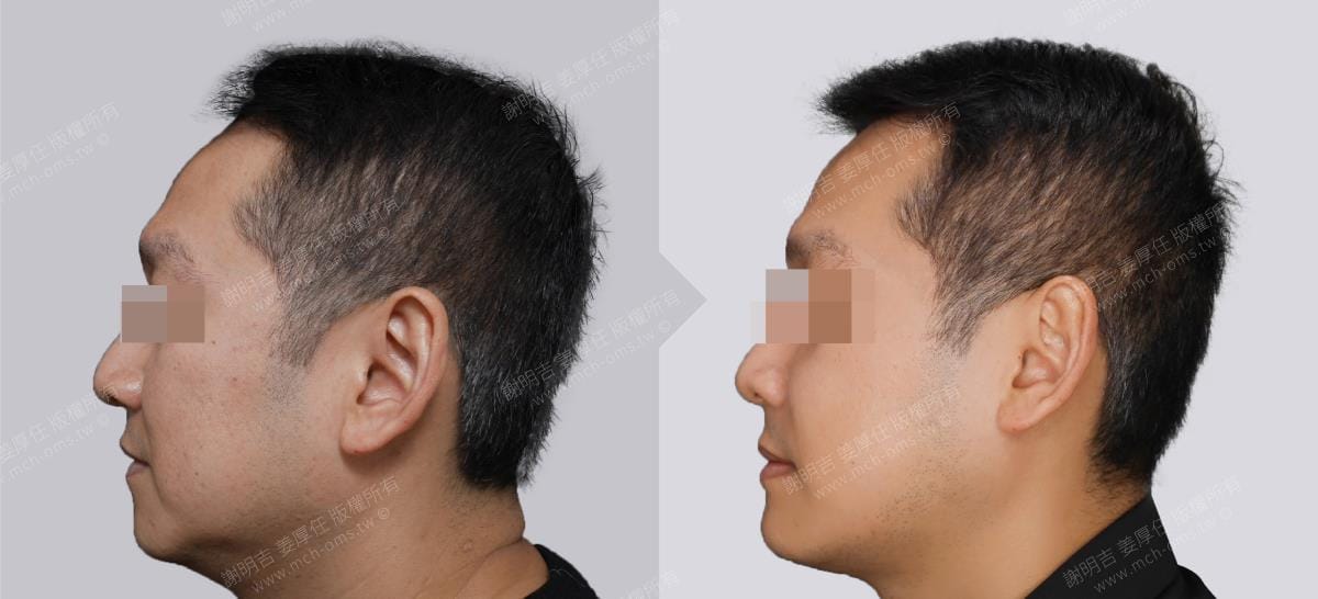 鼾聲如雷竟是呼吸中止症惹的禍 2 正顎手術前後左側臉部輪廓對比