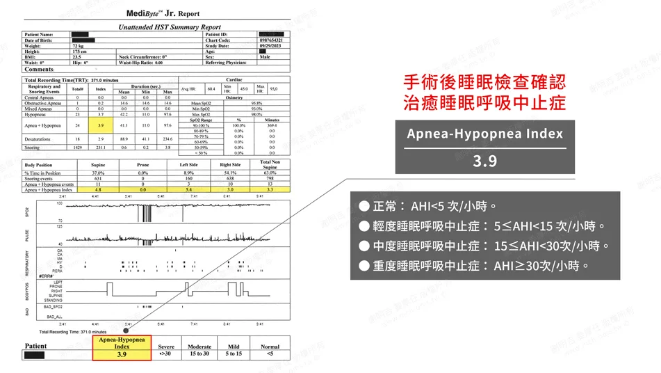 頭痛易怒原來是嚴重阻塞性睡眠呼吸中止惹得禍 2 術後睡眠檢查報告,AHI降至3.9
