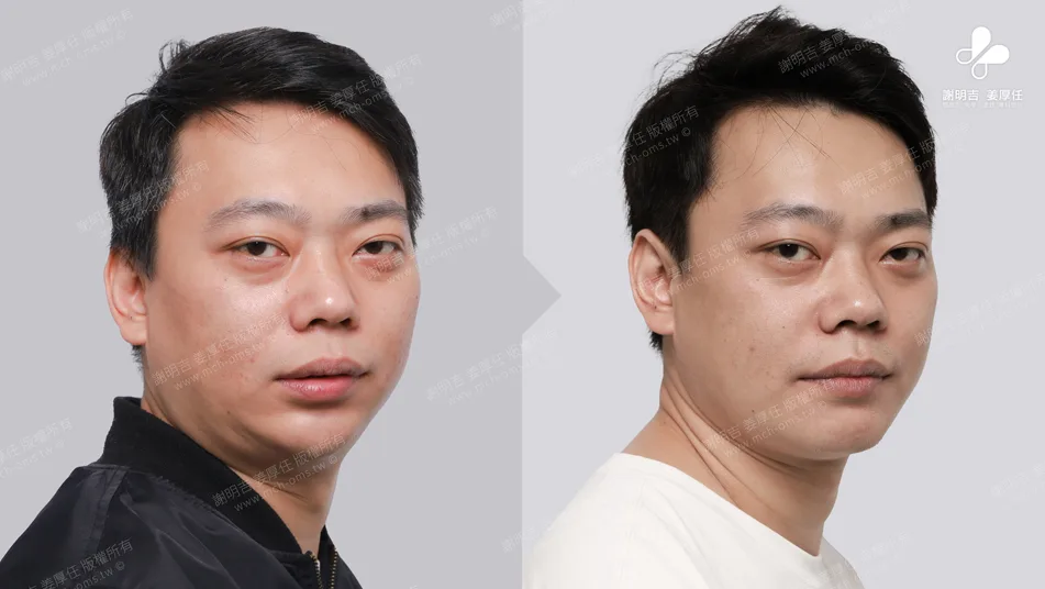 正颚手术案例：下巴及下颚骨后缩