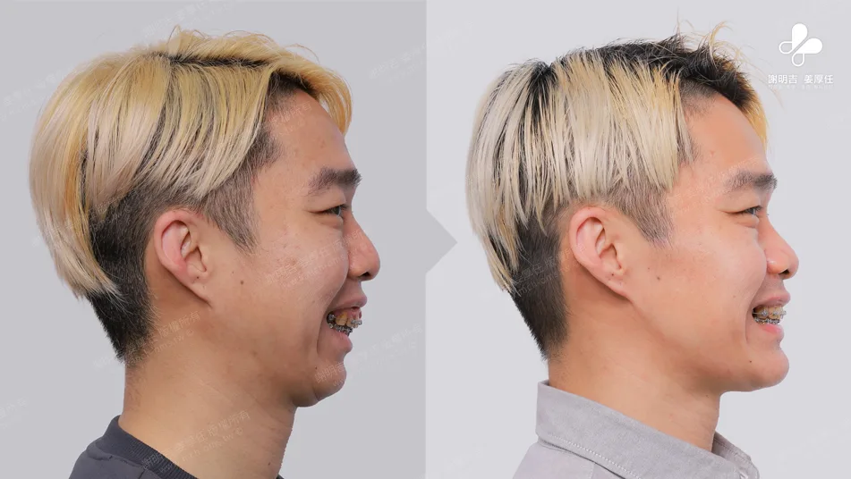 MMA surgery to treat sleep apnea 8 Comparison of facial smile contours before and after orthognathic surgery