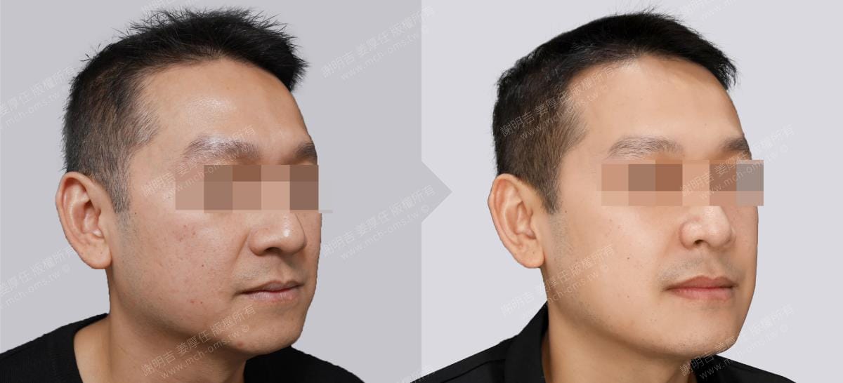 鼾聲如雷竟是呼吸中止症惹的禍 4 正顎手術前後右側45度斜面外觀對比