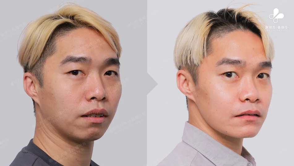 MMA Surgery to Treat Sleep Apnea 5 Comparison of 45-degree bevel appearance before and after orthognathic surgery