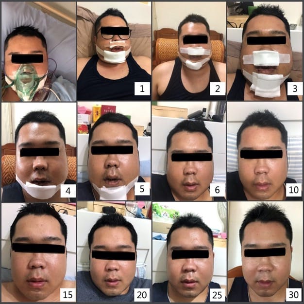 睡眠呼吸中止:下顎後縮壓迫呼吸道 8 正顎手術後第1天至第30天的臉部恢復過程紀錄