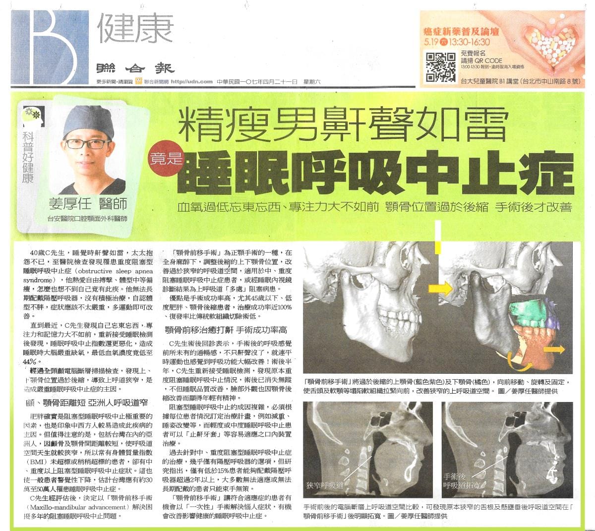 鼾聲如雷竟是呼吸中止症惹的禍 10 聯合報健康版剪報,說明顎骨前移手術治療睡眠呼吸中止症