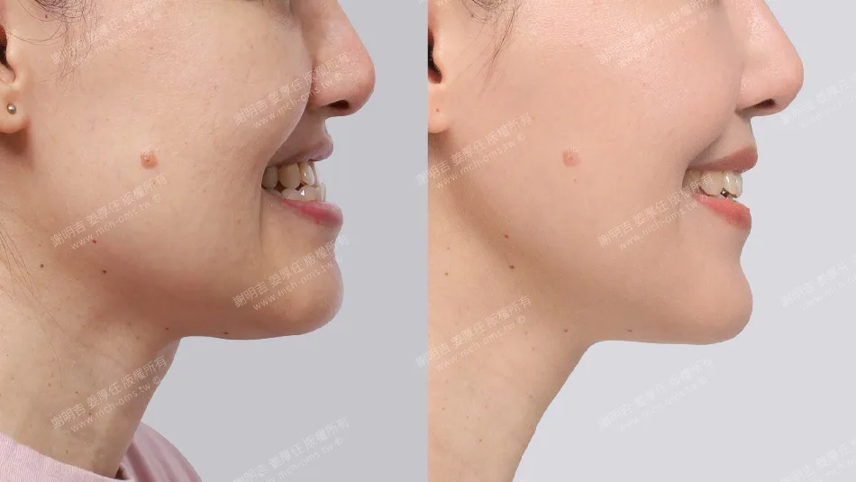 女性戽斗呼吸中止症治疗