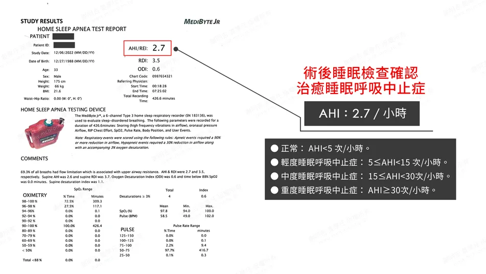 MMA surgery to treat sleep apnea 2 Post-operative home sleep monitoring report: AHI dropped to 2.7.