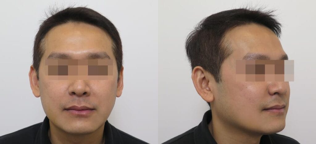 鼾聲如雷竟是呼吸中止症惹的禍 8 正顎手術後兩週回診的正面與斜側面外觀