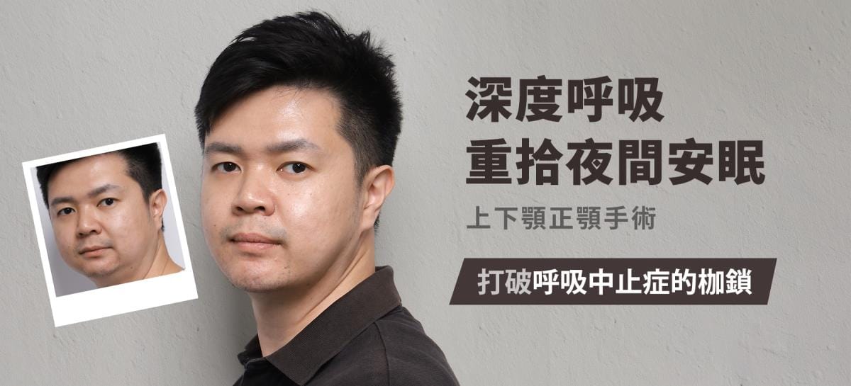 重度睡眠呼吸中止症患者接受上下顎正顎手術的案例主視覺