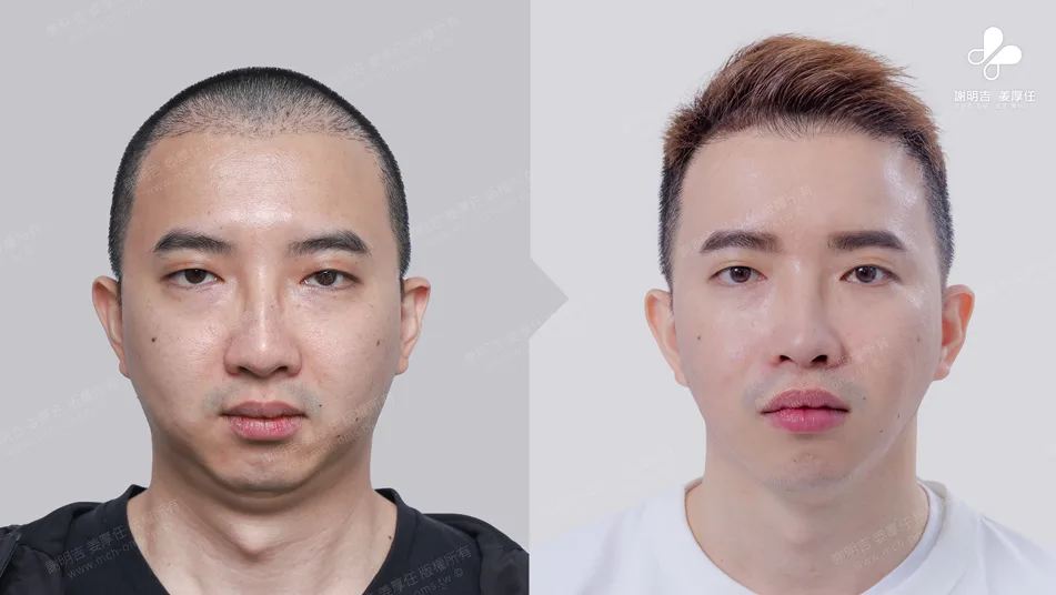 頭痛易怒原來是嚴重阻塞性睡眠呼吸中止惹得禍 4 重度睡眠呼吸中止症患者MMA手術前後正面外觀對比