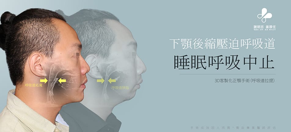 白天嗜睡患者3D客製化正顎手術前後側臉與呼吸道拓寬對比