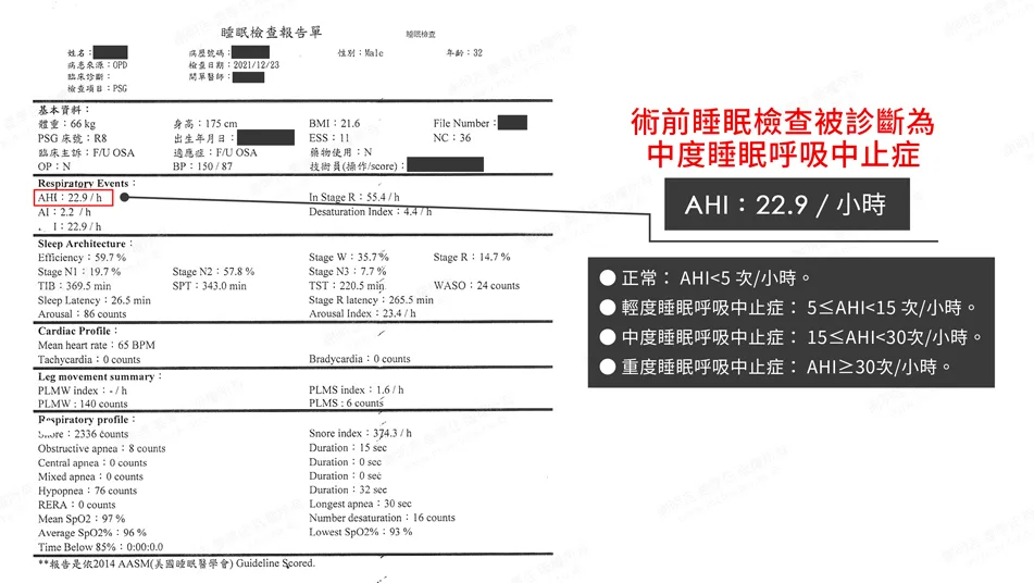 MMA surgery to treat sleep apnea 1 The preoperative sleep study report, with an AHI of 22.9, indicated moderate sleep apnea.
