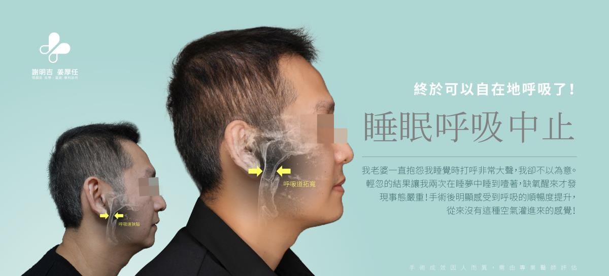 睡眠呼吸中止症患者正顎手術前後側臉與呼吸道狹隘拓寬對比