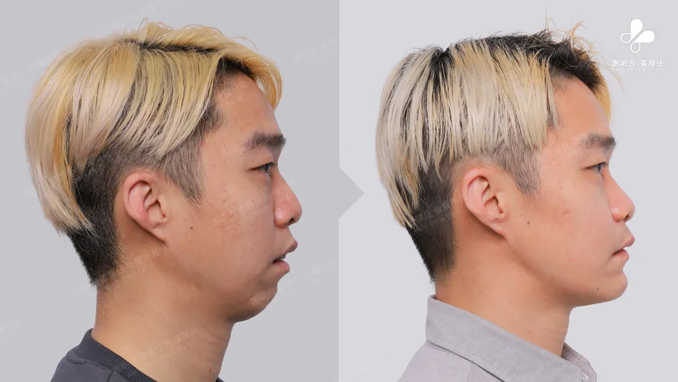 MMA surgery to treat sleep apnea 7 Comparison of chin and jaw contours before and after orthognathic surgery