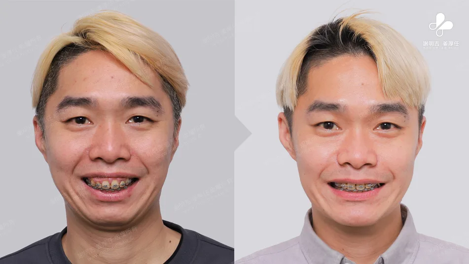 MMA surgery to treat sleep apnea 4 A before-and-after comparison of a smile after orthognathic surgery, showing the corrective device.