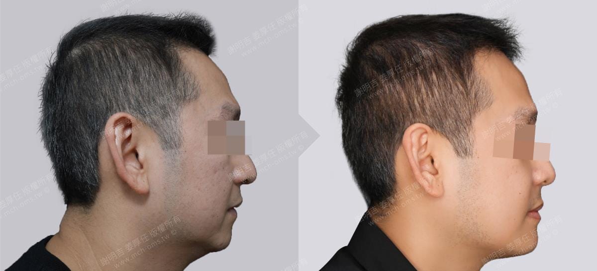 鼾聲如雷竟是呼吸中止症惹的禍 5 正顎手術前後右側臉部與下顎輪廓對比