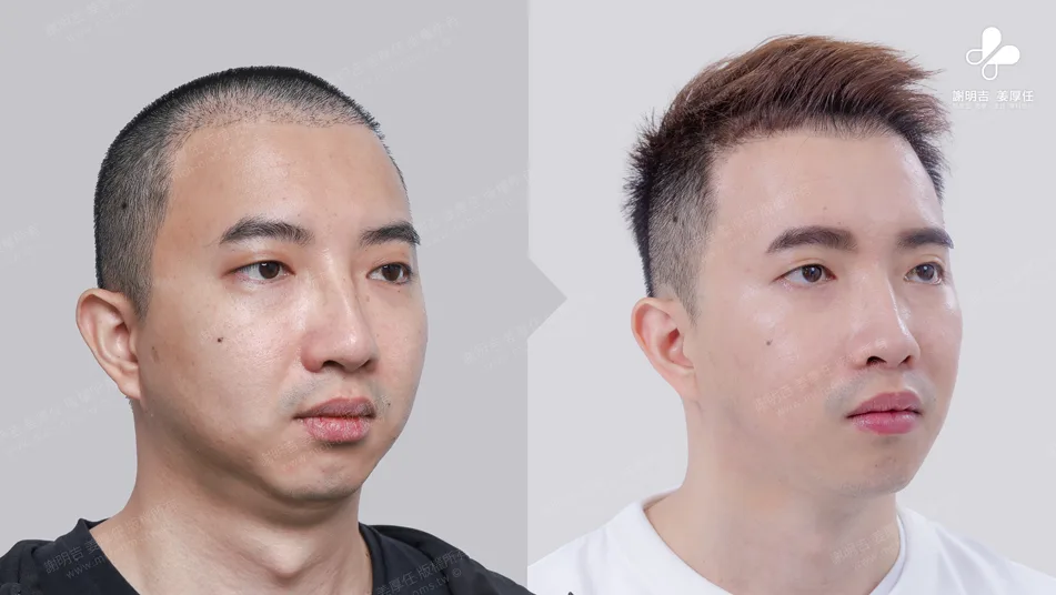 頭痛易怒原來是嚴重阻塞性睡眠呼吸中止惹得禍 6 頭痛易怒原來是嚴重阻塞性睡眠呼吸中止惹得禍
