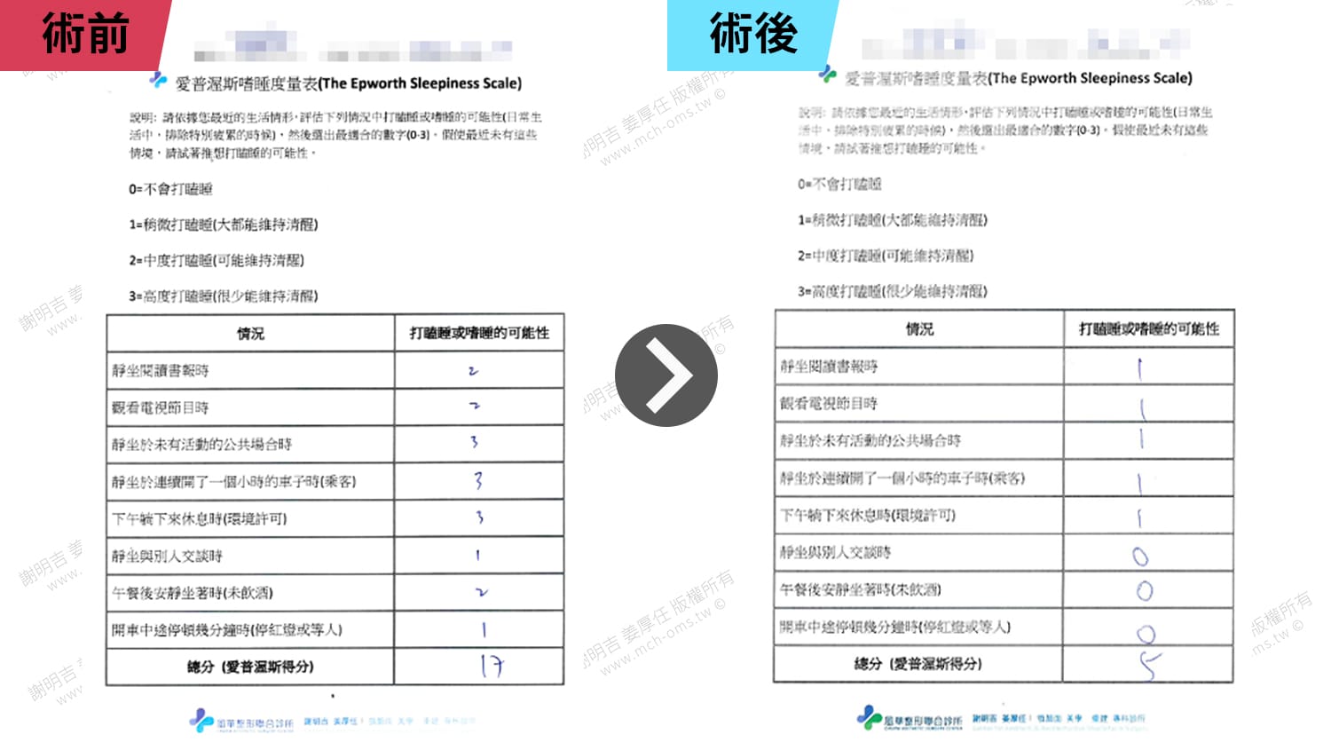 從AHI 64.5到4.3!術後重獲清醒人生 6 愛普渥斯嗜睡量表術前術後對比,總分由17降至5
