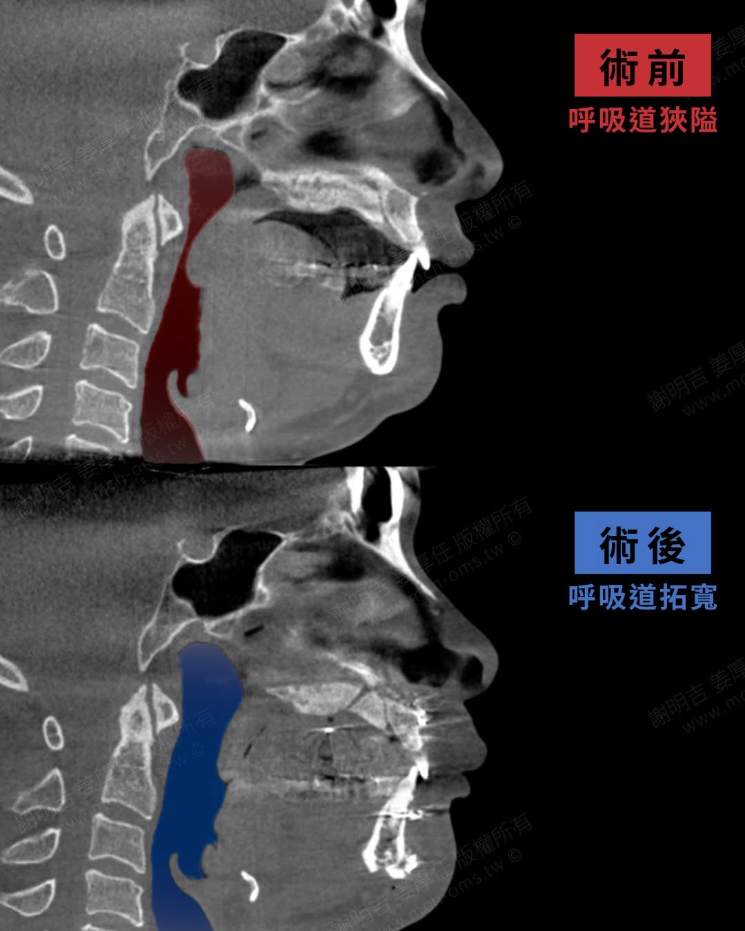 開刀房現場直擊:下顎後縮合併重度睡眠呼吸中止症,MMA正顎手術的氣道結構變化! 2 下顎後縮合併重度睡眠呼吸中止症(OSA)患者接受MMA正顎手術前後的電腦斷層氣道空間對比