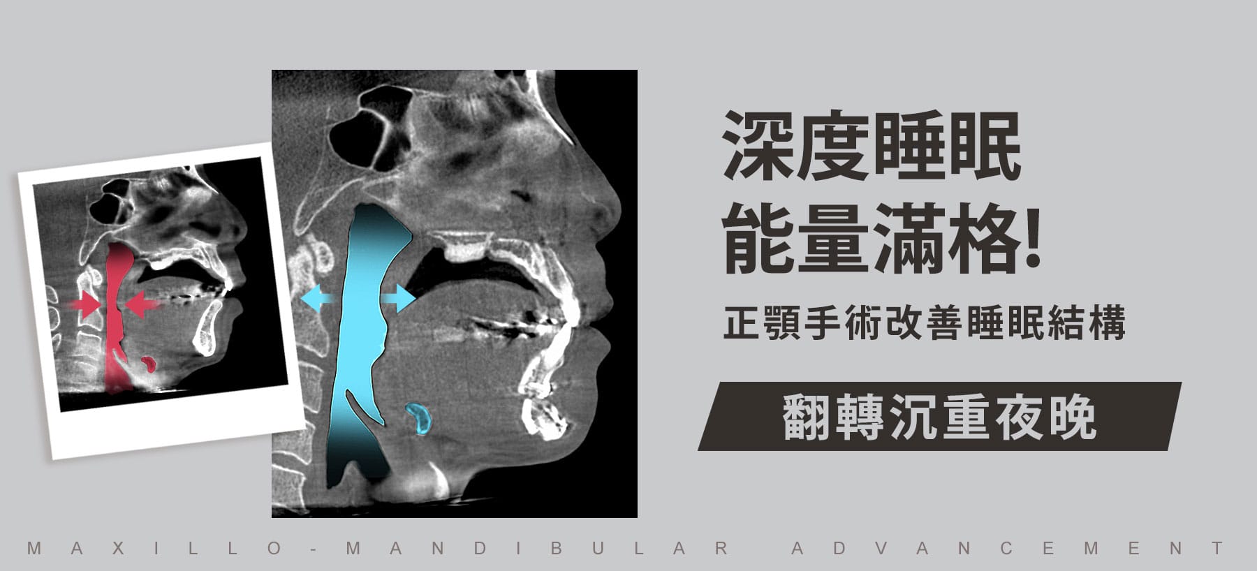 深度睡眠能量滿格！正顎手術改善睡眠結構翻轉沉重夜晚