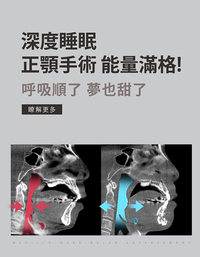 深度睡眠 正顎手術 能量滿格! 呼吸順了 夢也甜了