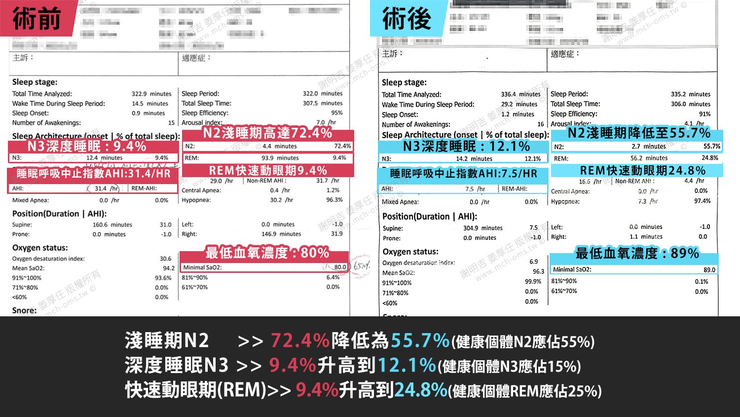 深度睡眠 正顎手術 能量滿格! 呼吸順了 夢也甜了 3 睡眠結構術前術後對比,AHI由31.4降至7.5、深度睡眠N3由9.4%升至12.1%