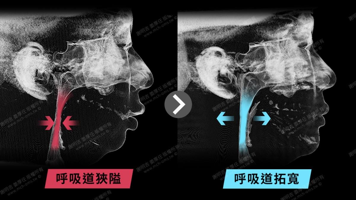 做過拔牙矯正,因為呼吸中止再做正顎手術 9 正顎手術前後呼吸道立體斷層對比,術後呼吸道由狹隘變為拓寬