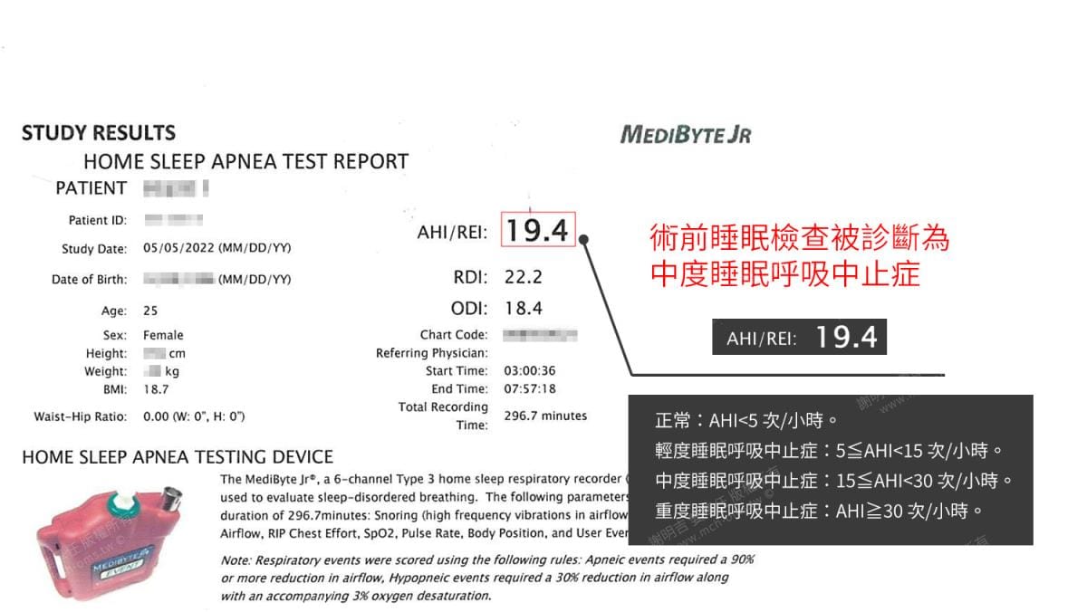 做過拔牙矯正,因為呼吸中止再做正顎手術 10 術前居家睡眠檢測報告,AHI 19.4判定為中度睡眠呼吸中止症