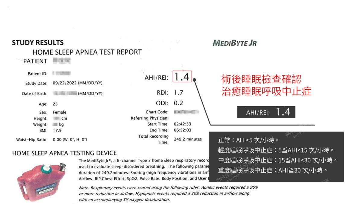 做過拔牙矯正,因為呼吸中止再做正顎手術 11 術後居家睡眠檢測報告,AHI降至1.4