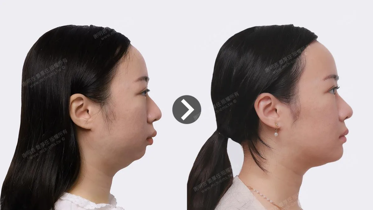 术后对比