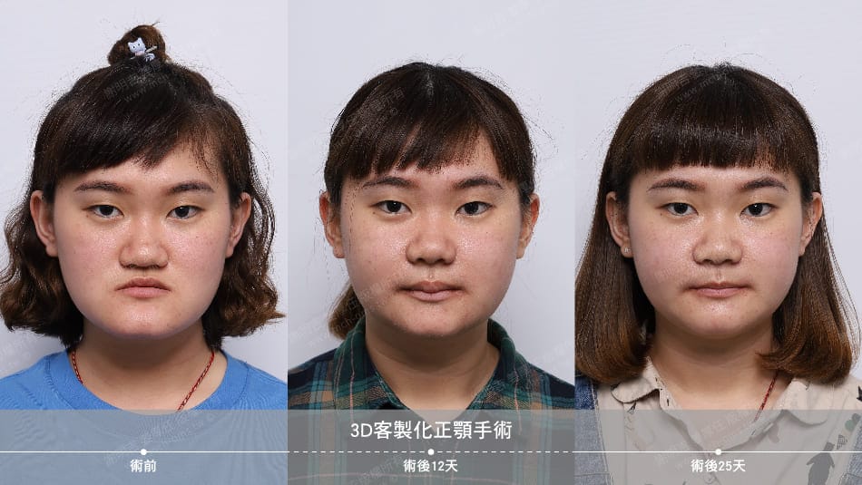 咬合不正与下巴突出案例分享