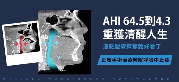 正顎手術治療睡眠呼吸中止症案例主視覺，AHI由64.5降至4.3