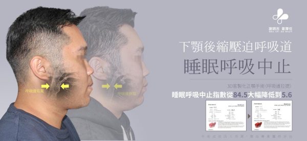 下顎後縮患者3D客製化正顎手術前後側臉與呼吸道對比
