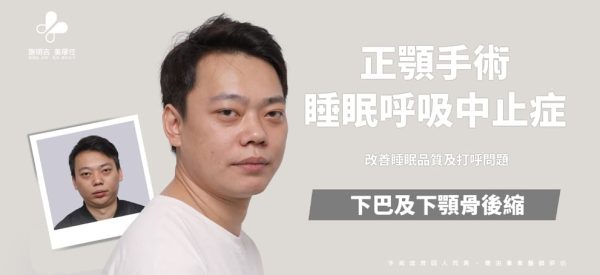 打鼾困擾患者正顎手術案例主視覺，標示下巴及下顎骨後縮